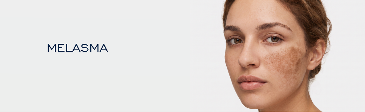 Melasma